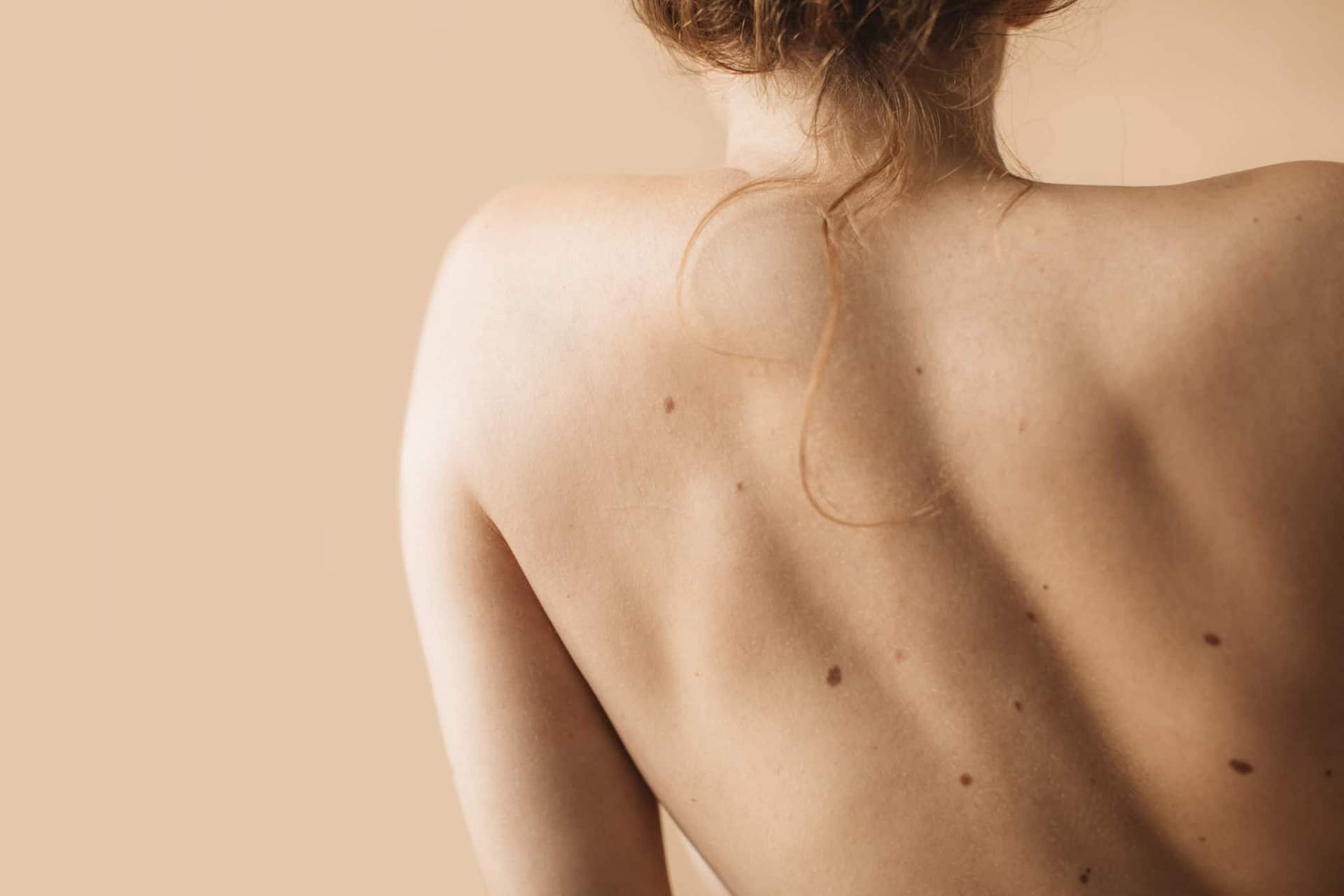 Segnali che qualcosa non va con il tuo neo: il dermatologo risponde — Salute