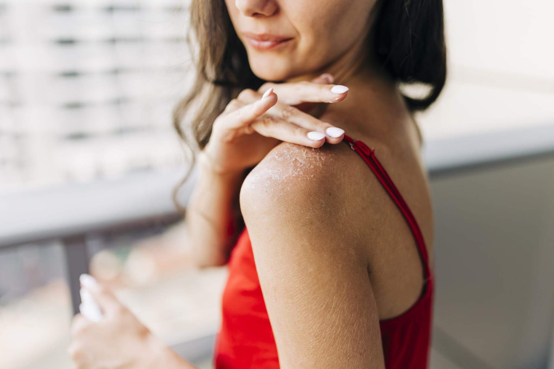 5 solutions naturelles SOS contre les coups de soleil — Santé