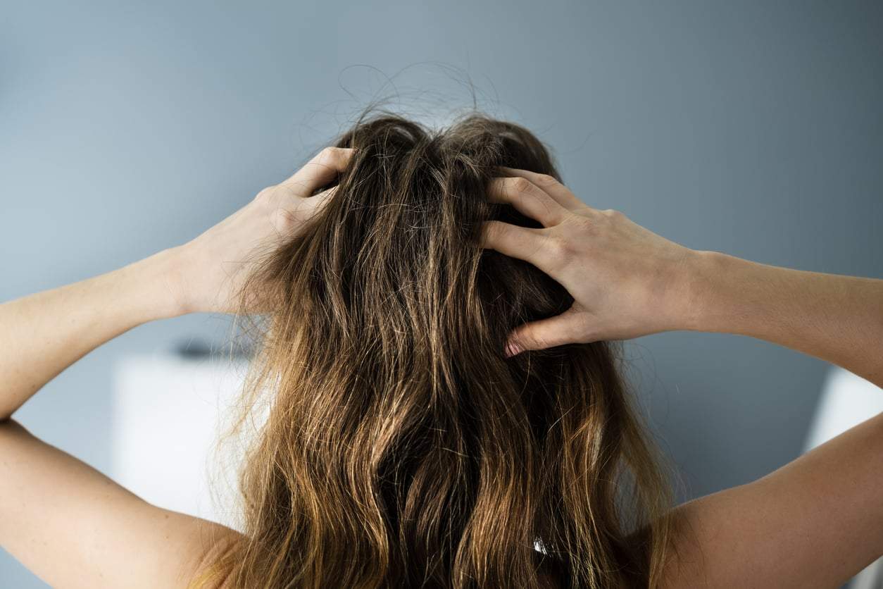 Im Herbst kann die Kopfhaut wieder schuppen. Mit diesen Hausmitteln verschwindet der Schuppen — Haare