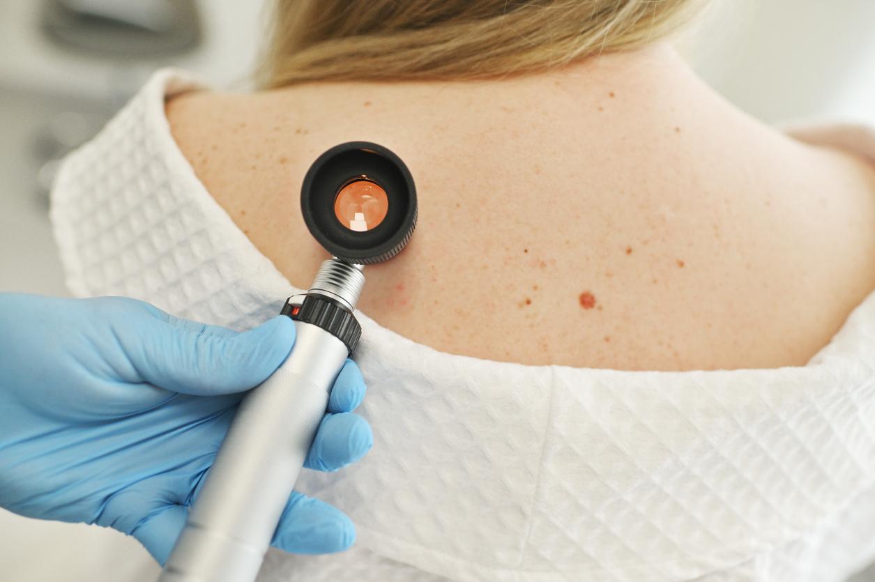 Neue Studie: Ein häufiger Virus könnte auch bei der Entstehung von Hautkrebs eine Rolle spielen — Gesicht