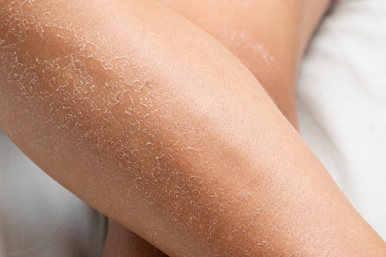 Schuppt deine Haut an den Beinen im Winter? Darum passiert das und so hilft du ihr — Gesundheit
