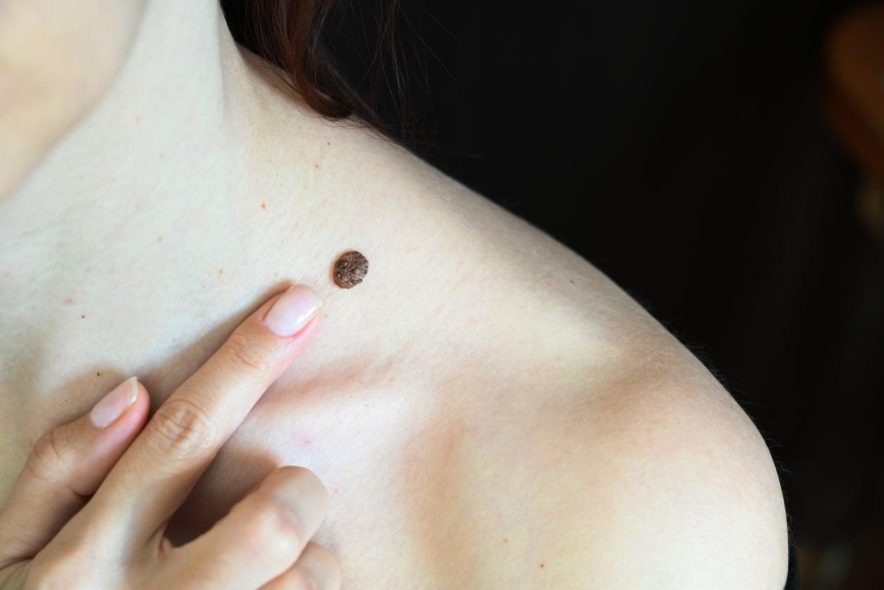 What the Location of Your Mole on Your Neck Reveals About You, According to Ancient Belief — Lifestyle