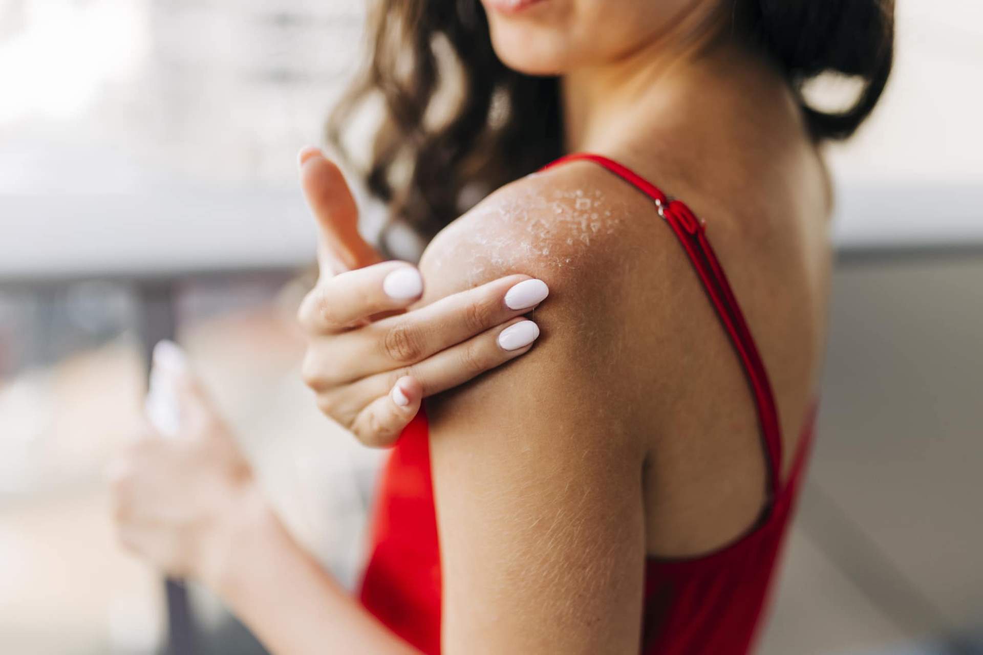 Solutions naturelles contre les coups de soleil : les 5 meilleurs remèdes maison — Style