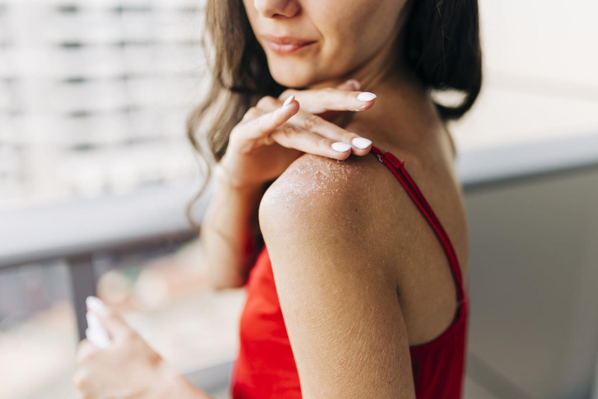 5 rimedi naturali urgenti per scottature solari — Salute