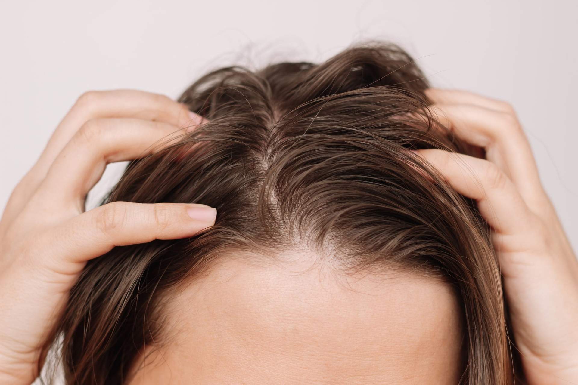 Schuppen, Haarausfall, fettige Kopfhaut? Es könnte mehr dahinterstecken — Haare