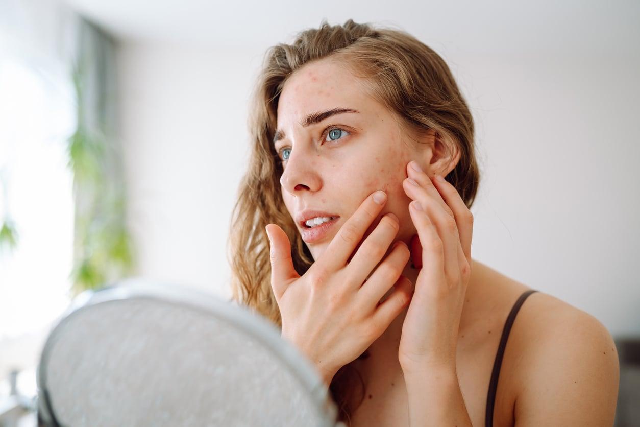 Why Your Skin Gets Worse When You Start Eating Healthy — Face
