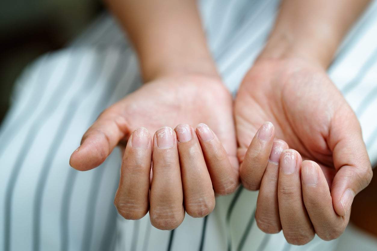 5 señales en tus uñas que no indican falta de vitaminas, sino un problema serio de tiroides — Salud