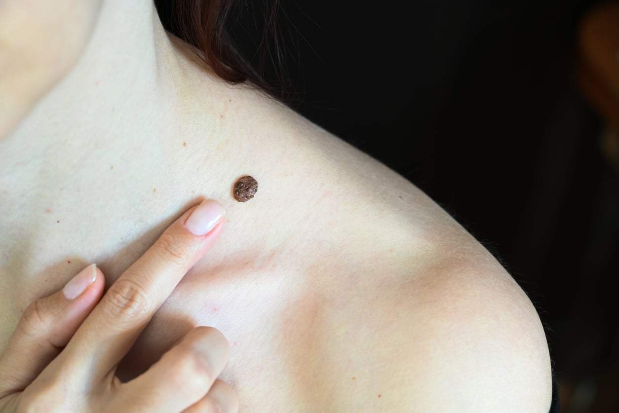 What the Location of Your Mole on Your Neck Reveals About You, According to Ancient Belief — Lifestyle
